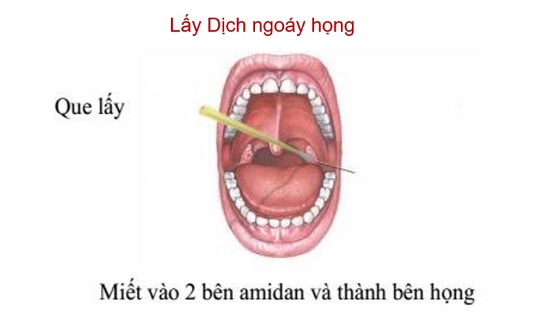Cách lấy dịch ngoáy họng để xét nghiệm sởi