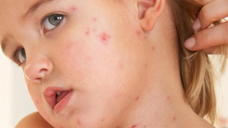 Bệnh sởi do virus Paramyxoviridae gây ra, dễ mắc nhất ở trẻ em