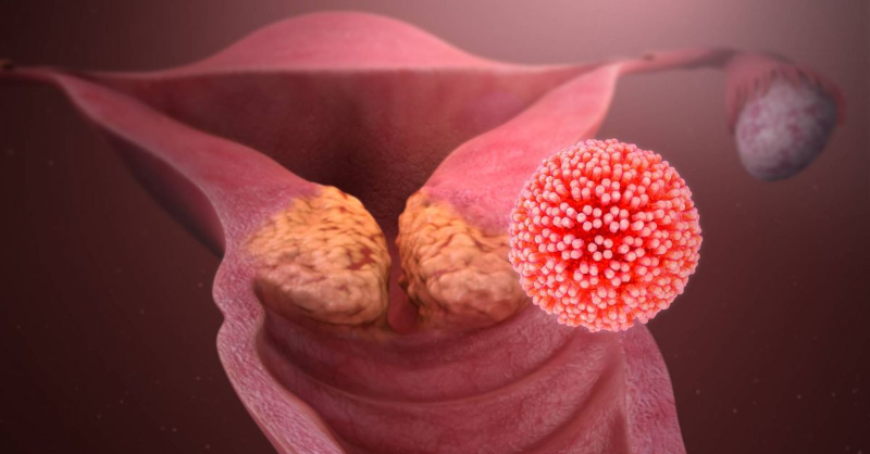 HPV là nguyên nhân chủ yếu gây ra ung thư cổ tử cung ở nữ giới 