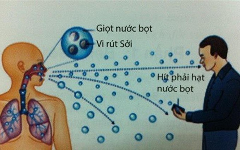 Virus gây bệnh sởi dễ dàng lây lan qua giọt bắn từ người bệnh