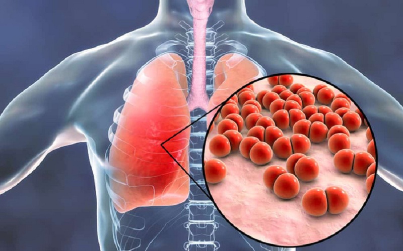 Sởi có thể biến chứng viêm phổi nếu chăm sóc khi trẻ bị sởi không đúng cách