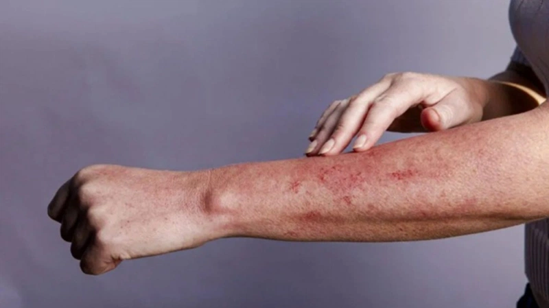 HIV thường tiến triển qua ba giai đoạn 