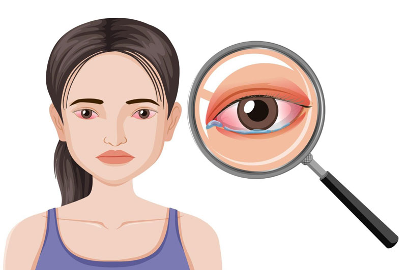 Đau mắt đỏ khiến người bệnh bị giảm thị lực tạm thời, cảm thấy đau ngứa khó chịu