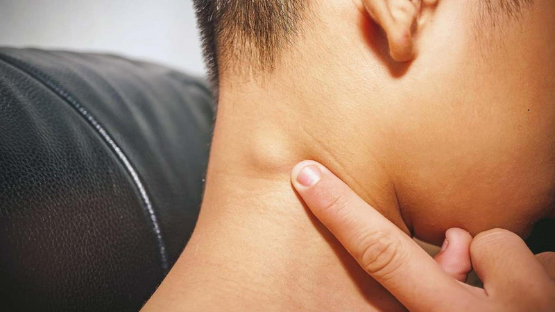 Nổi hạch là một trong những dấu hiệu nhiễm HIV sau 2-4 tuần 
