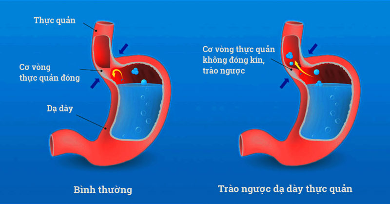 Trào ngược dạ dày - thực quản là một trong những bệnh tiêu hóa thường gặp