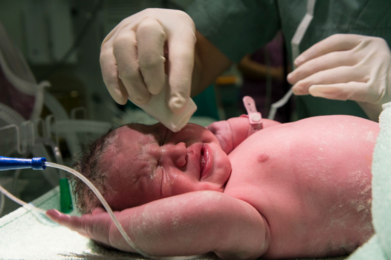 Ngay sau khi sinh, trẻ cần được đo Apgar 
