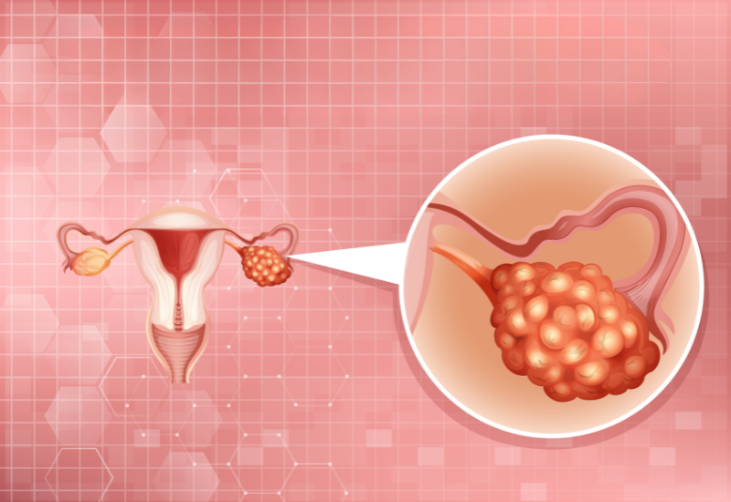 Đa số các trường hợp u nang buồng trứng thường lành tính và không gây nguy hiểm cho sức khỏe