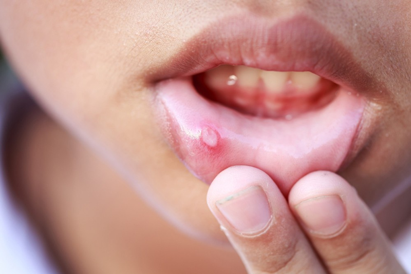 Nhiệt miệng ở trẻ là vấn đề rất phổ biến