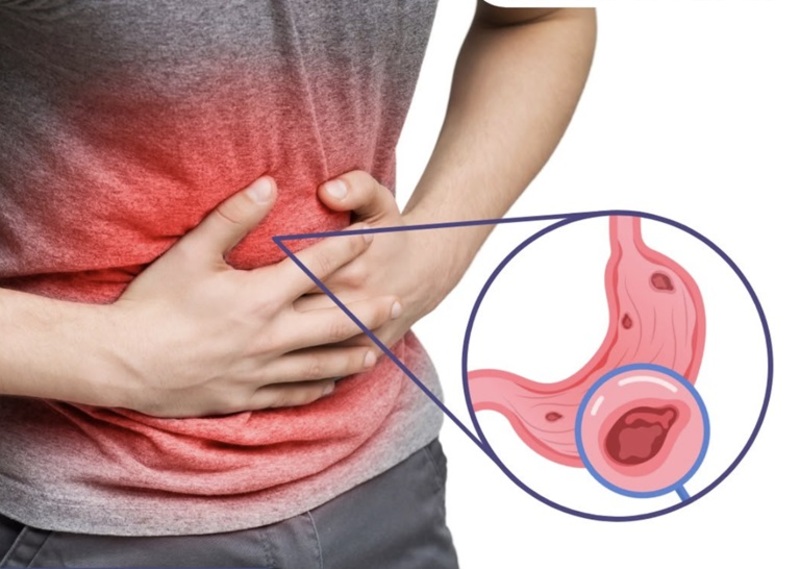 Loét dạ dày - tá tràng là nguyên nhân phổ biến gây xuất huyết tiêu hóa