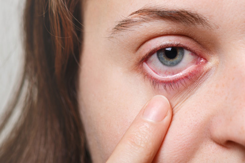 Thuốc kháng Histamin giúp kiểm soát triệu chứng khó chịu khi bị đau mắt đỏ