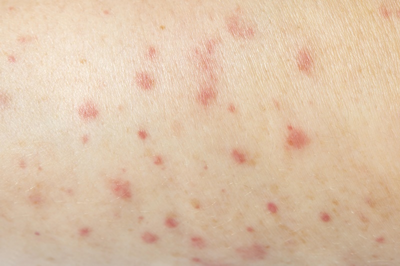 Bệnh sởi có thể gây phát ban trên da
