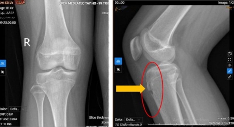 Kết quả chụp X-quang khớp gối phải ghi nhận hình ảnh vị trí lồi củ trước xương chày phải bờ không đều