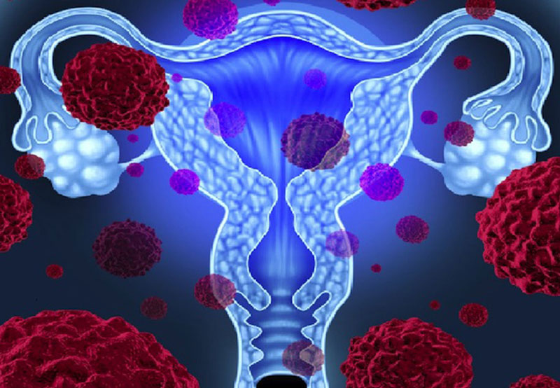 Tỷ lệ người bệnh ung thư cổ tử cung do HPV type 18 gây ra chiếm đến gần 70%