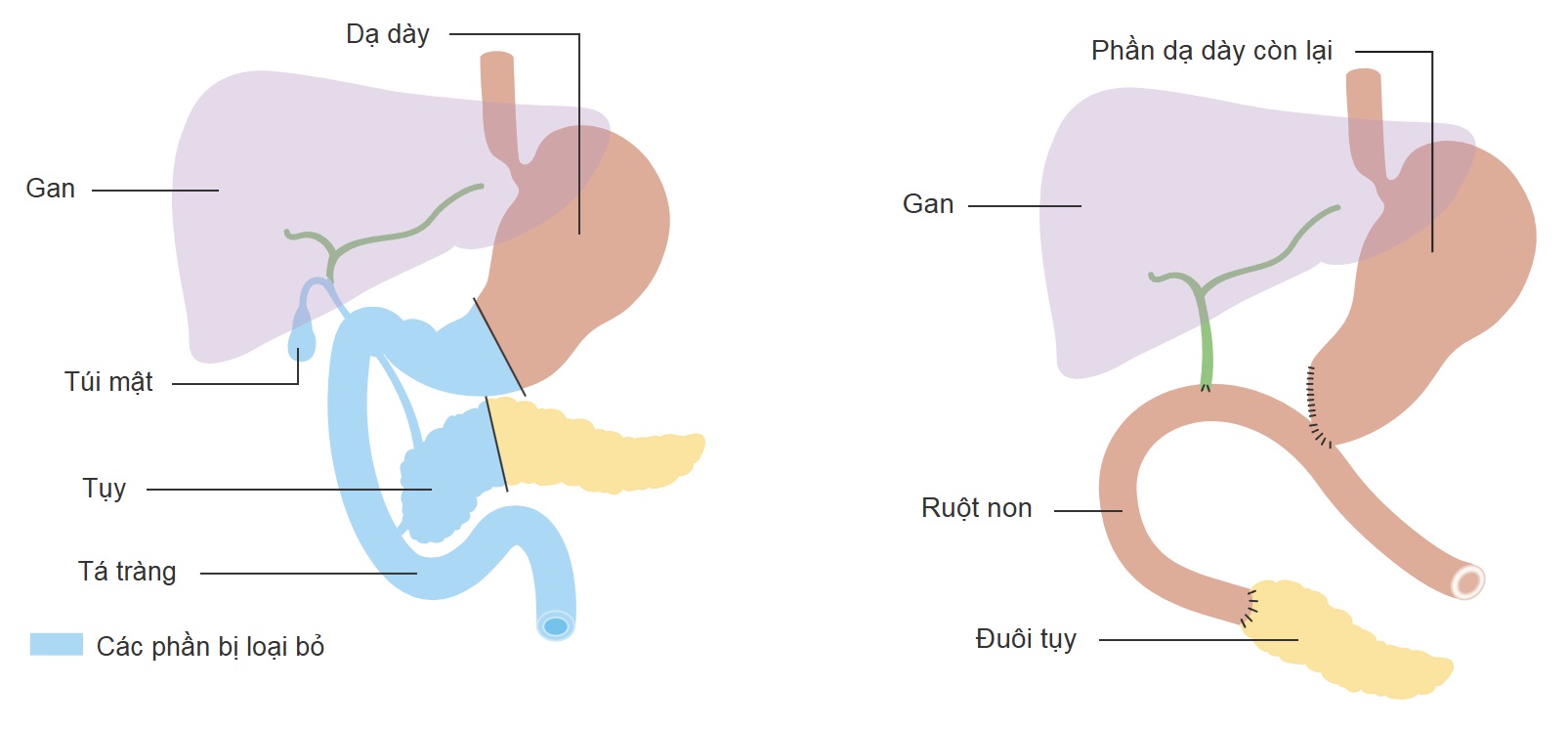  Phẫu thuật cắt khối tá tuỵ trong ung thư biểu mô tuyến ống tuỵ