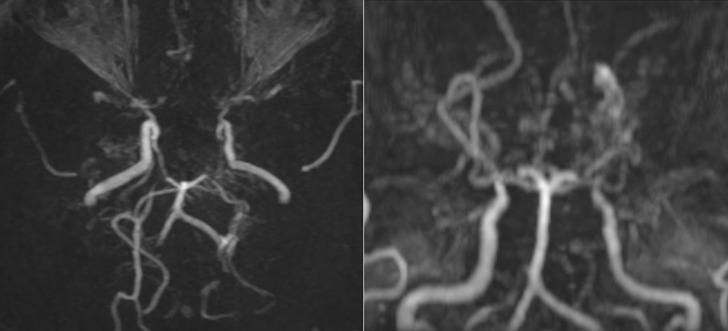 Các mạch máu não của bệnh nhân nhìn như “làn khói thuốc lá” trên phim chụp MRI 