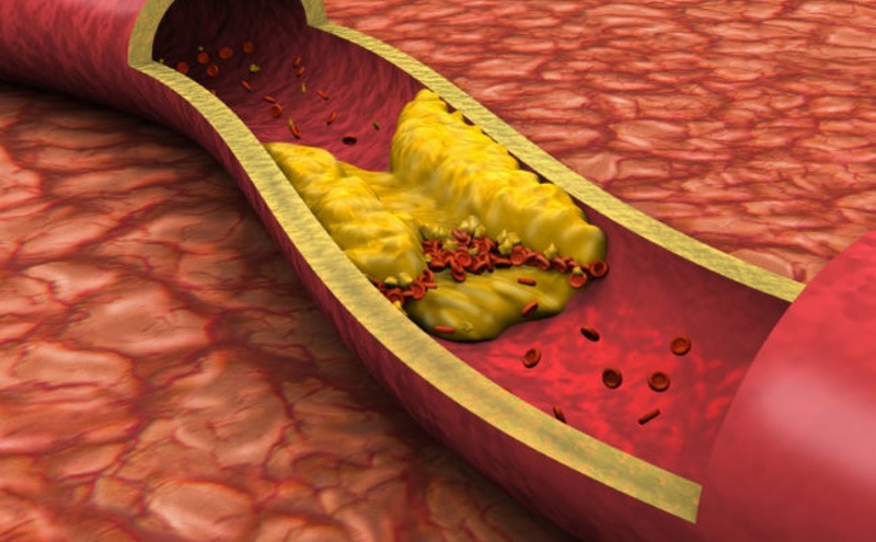 Mỡ máu cao là tình trạng cholesterol và triglyceride trong máu vượt mức bình thường