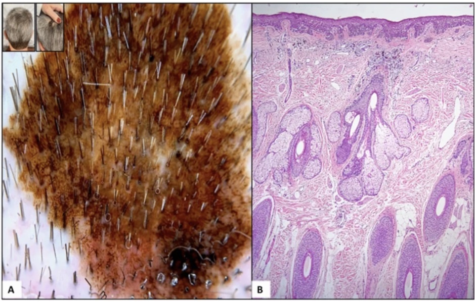 Hình ảnh Dermatoscopy và mô bệnh học của ung thư hắc tố