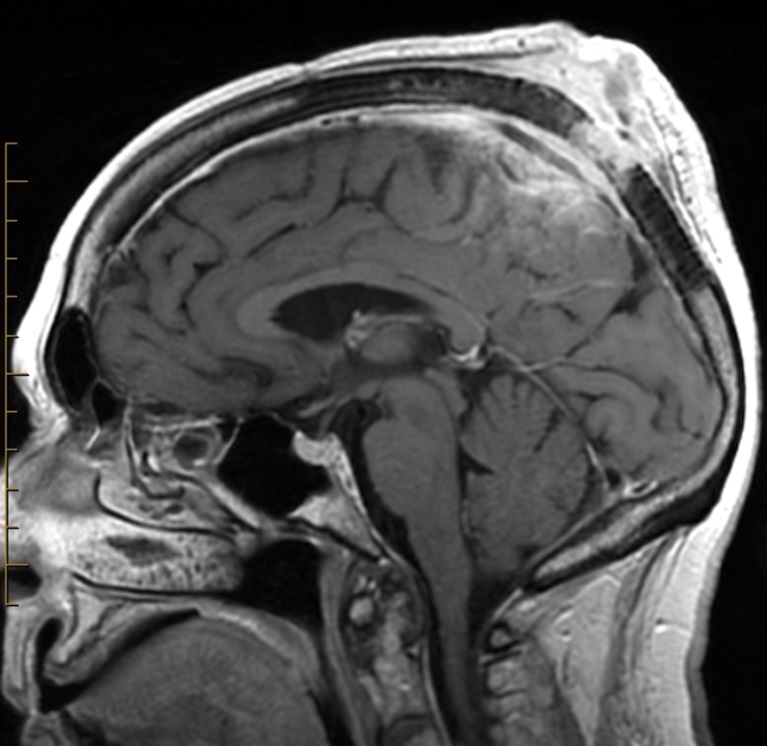 Hình ảnh MRI một trường hợp ung thư biểu mô tế bào vảy vùng đỉnh đầu xâm lấn