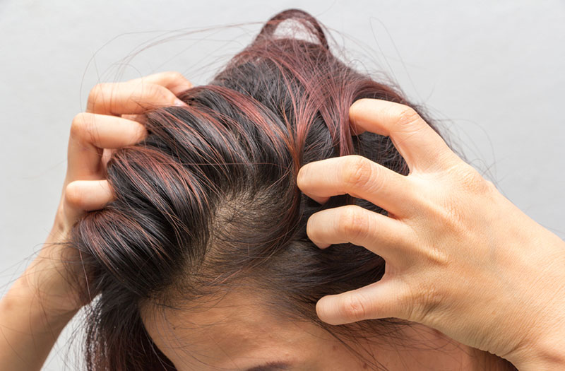 Có liệu pháp hoặc phương pháp phòng ngừa nào để tránh đau da đầu trên đỉnh đầu?
