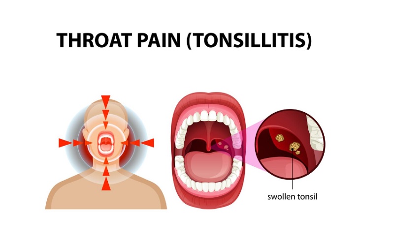 Rát lưỡi, đau họng có thể là dấu hiệu viêm amidan
