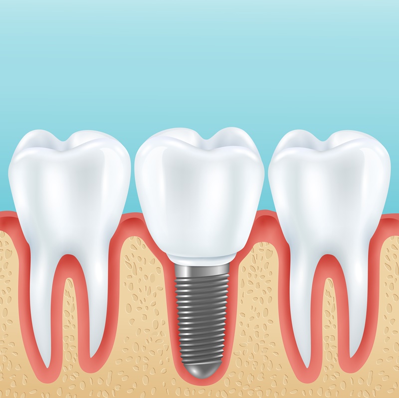 Trồng răng sứ cố định giúp người bệnh đảm bảo chức năng ăn nhai