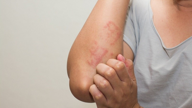 Lưu ý phản ứng dị ứng ở một số đối tượng khi ăn quả anh đào 