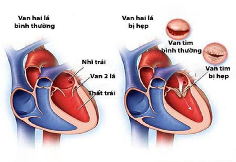 Triệu chứng thường gặp của hẹp van tim 2 lá là gì?
