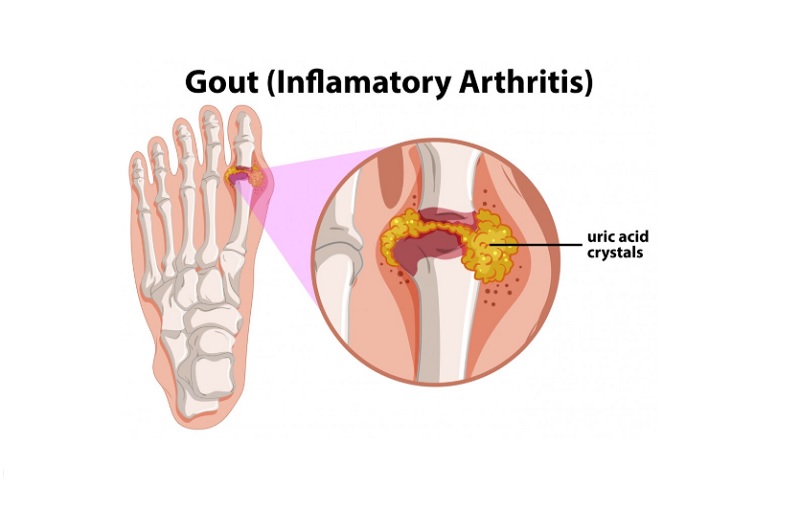 Hình ảnh mô phỏng sự gia tăng axit uric trong bệnh gout