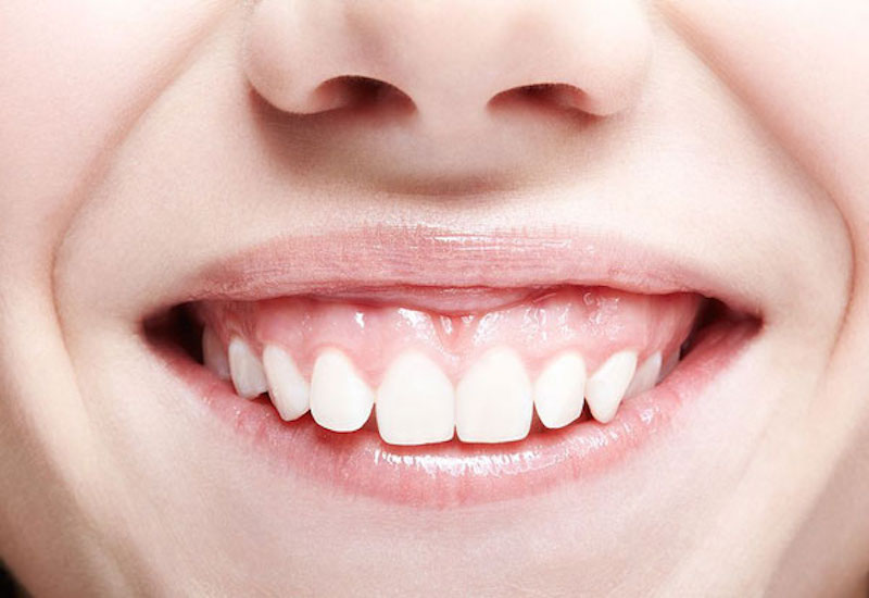 Các phương pháp khác để chỉnh nha răng hô hở lợi là gì?
