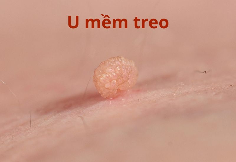 U mềm treo thường có hình dạng nhỏ, mềm