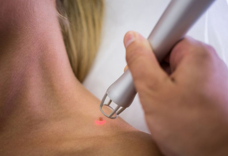 Đốt điện, đốt laser,... là các phương pháp cắt bỏ u mềm treo