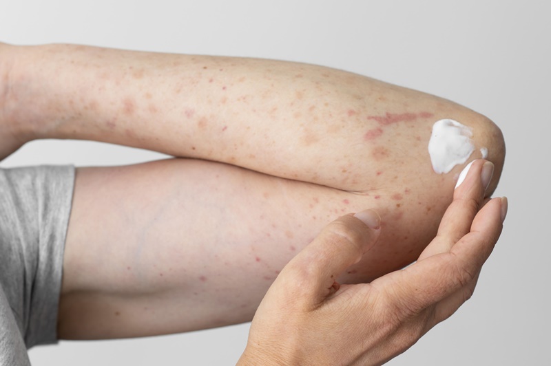 Bệnh nhân tiểu đường có nguy cơ cao bị nhiễm trùng