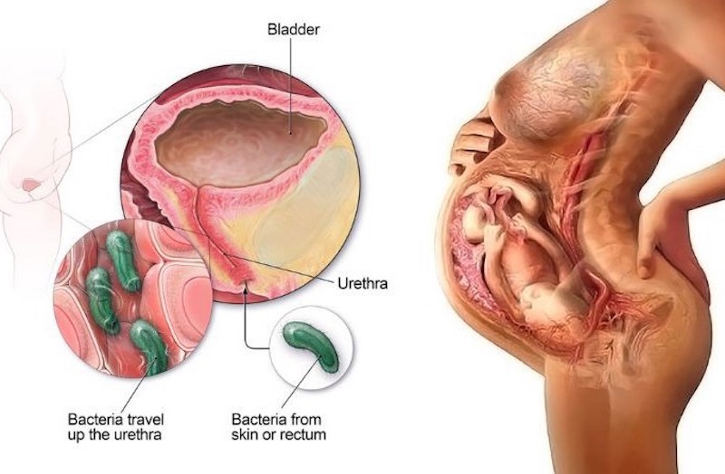 Trong thai kỳ, mẹ bầu có thể gặp phải tình trạng nhiễm khuẩn tiết niệu cần cảnh giác (Nguồn ảnh: Sưu tầm Internet) 