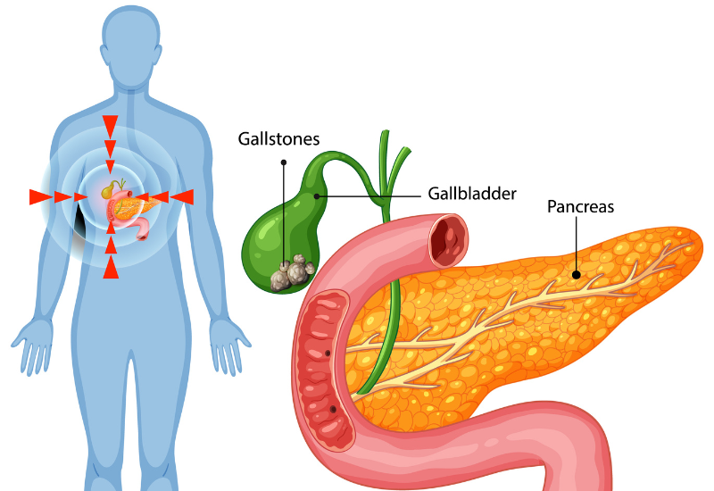 Sỏi mật gây đau, viêm hoặc tắc nghẽn đường mật là nguyên nhân phổ biến khiến người bệnh phải phẫu thuật