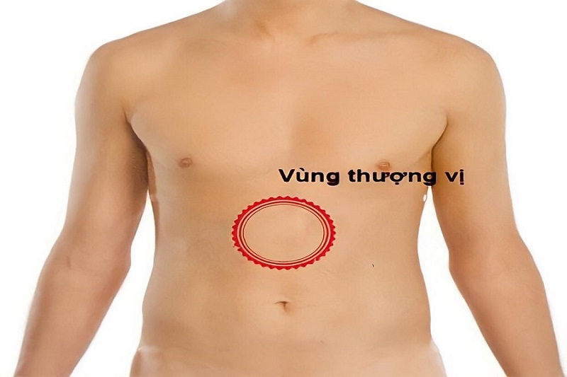 Bệnh nhân viêm tụy thường có triệu chứng đau bụng vùng thượng vị