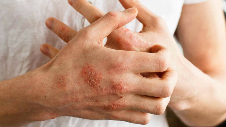 Người mắc các bệnh lý tự miễn không nên sử dụng đông trùng hạ thảo