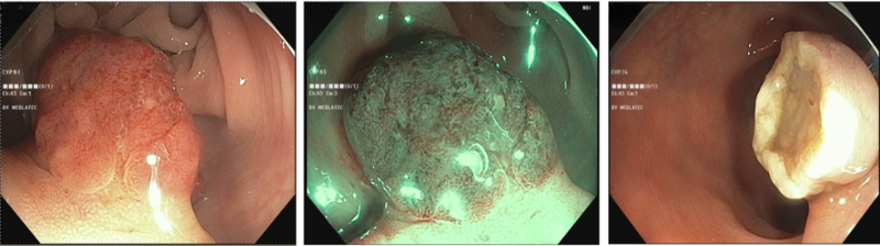 Hình ảnh polyp tại đại tràng sigma và trực tràng 