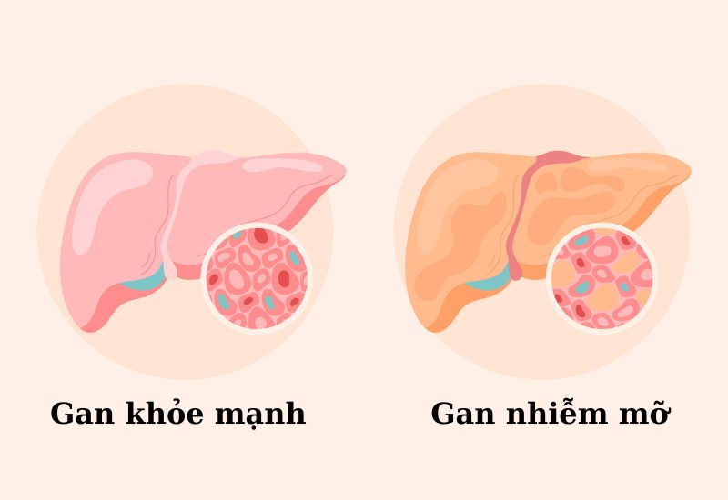 Gan nhiễm mỡ độ 2 là giai đoạn lượng mỡ chiếm khoảng 10 - 25% trong tế bào gan