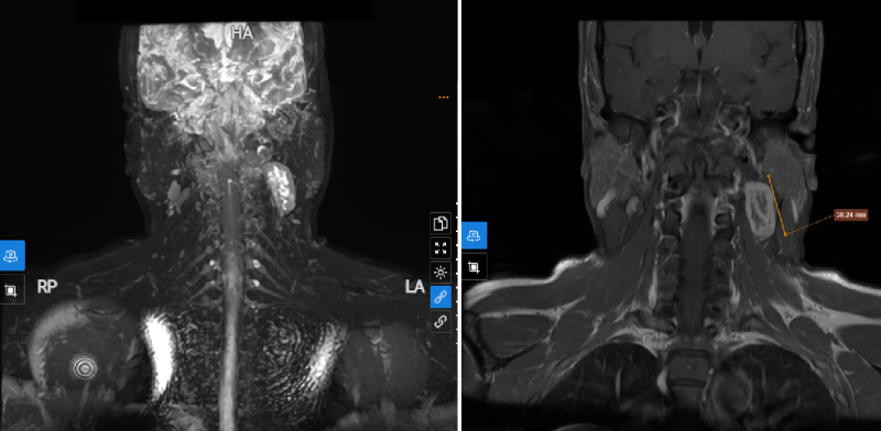 Tổn thương phát hiện trên phim chụp MRI vùng cổ  