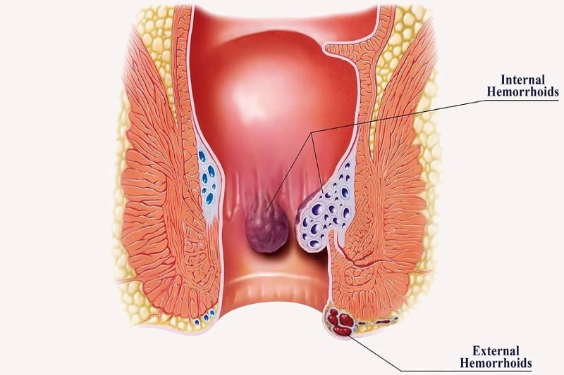 Hình ảnh mô phỏng búi trĩ trong bệnh trĩ
