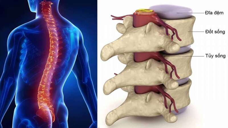 Thoái hóa cột sống thắt lưng là hệ quả của việc tổn thương phần xương dưới sụn và sụn
