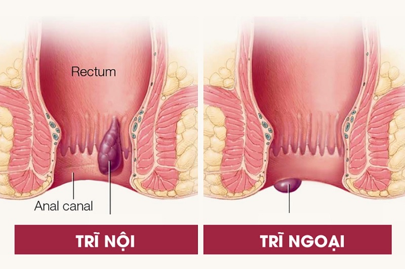 Hình ảnh giúp hình dung về vị trí xuất hiện của búi trĩ nội, trĩ ngoại