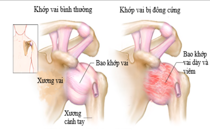 Hình ảnh viêm quanh khớp vai