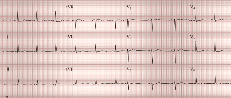 Tiêu chuẩn về tần số ngoại tâm thu nhĩ là gì?
