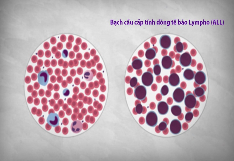 Ung thư máu dòng lympho B là gì?