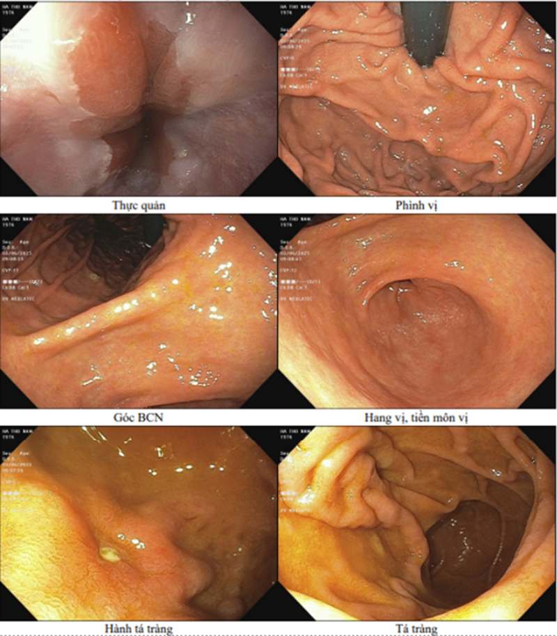 Kết quả nội soi tiêu hóa của bệnh nhân 