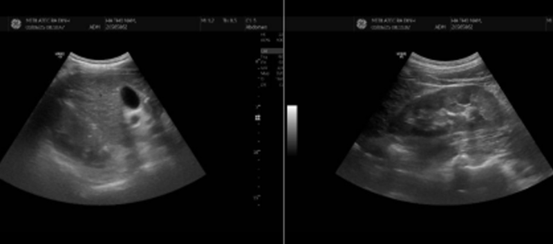 Kết quả siêu âm tổng quát có đàn hồi mô gan cho thấy hình ảnh nhu mô gan thô, bờ không đều 