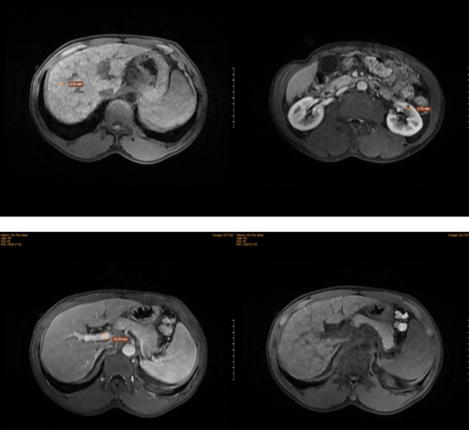 Chụp cộng hưởng từ tầng trên ổ bụng ghi nhận hình ảnh bất thường ở gan 