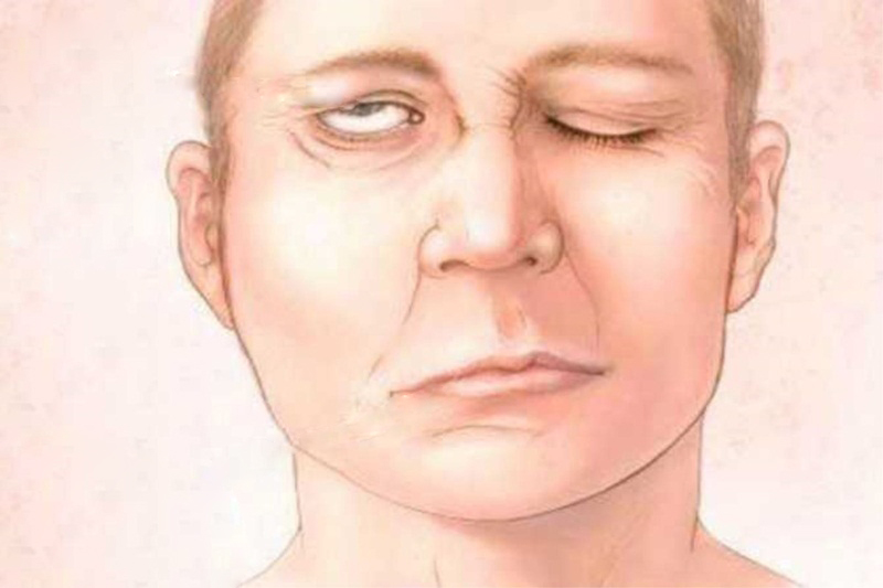 Bệnh nhân thấy miệng méo, mặt tê bì... sau khi tắm đêm bằng nước lạnh và nằm điều hòa. Ảnh minh họa