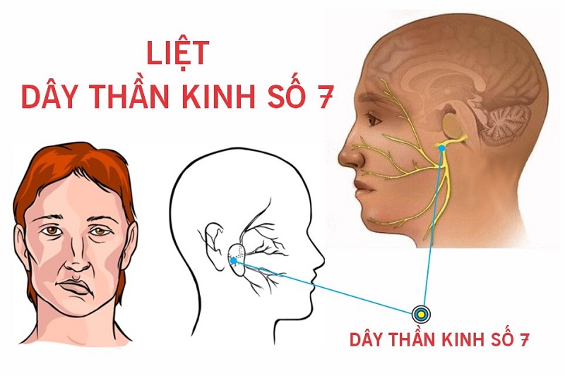 Liệt dây thần kinh số 7 gây liệt vận động trên khuôn mặt